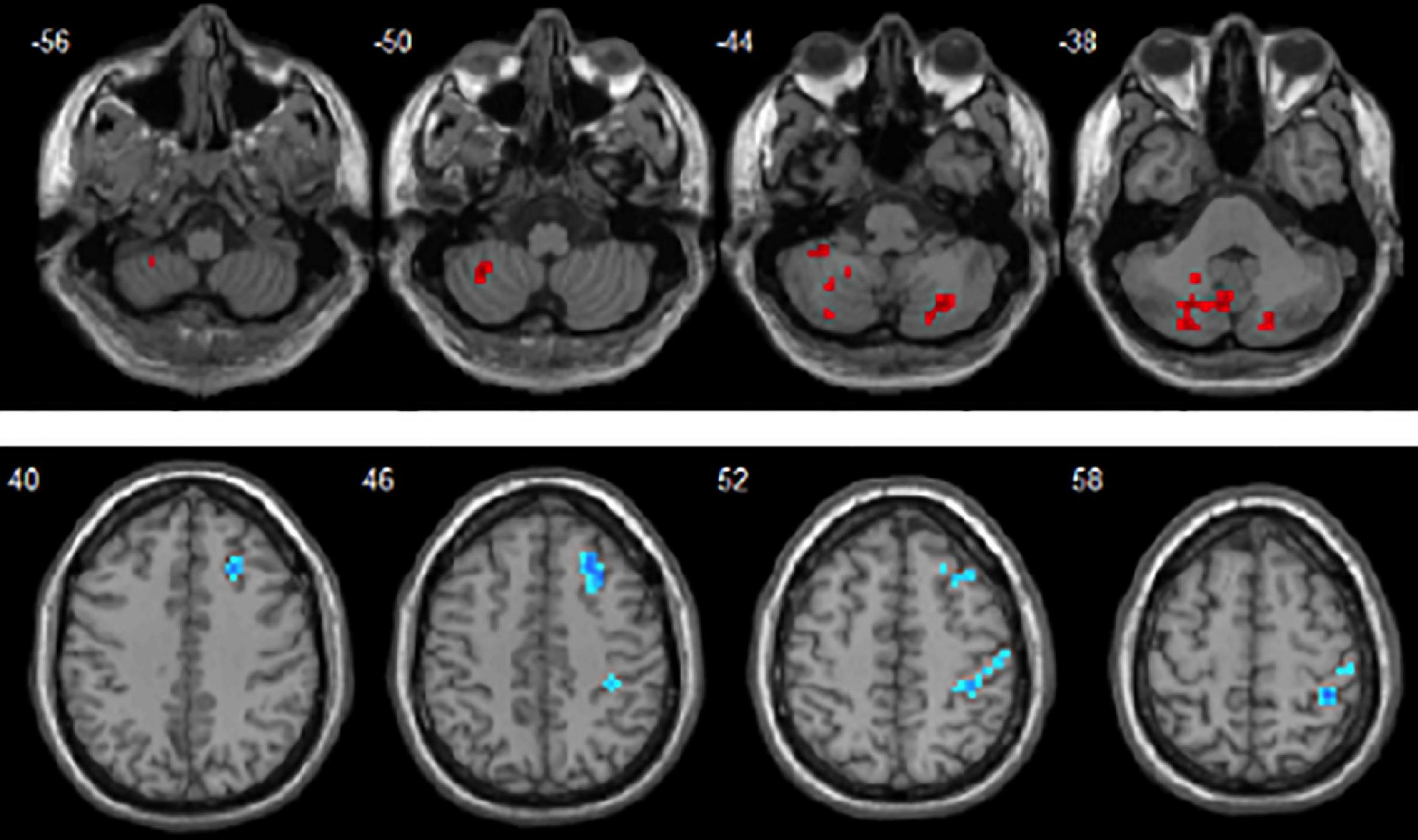 Potential dynamic regional brain biomarkers for early discrimination of autism and language development delay in toddlers